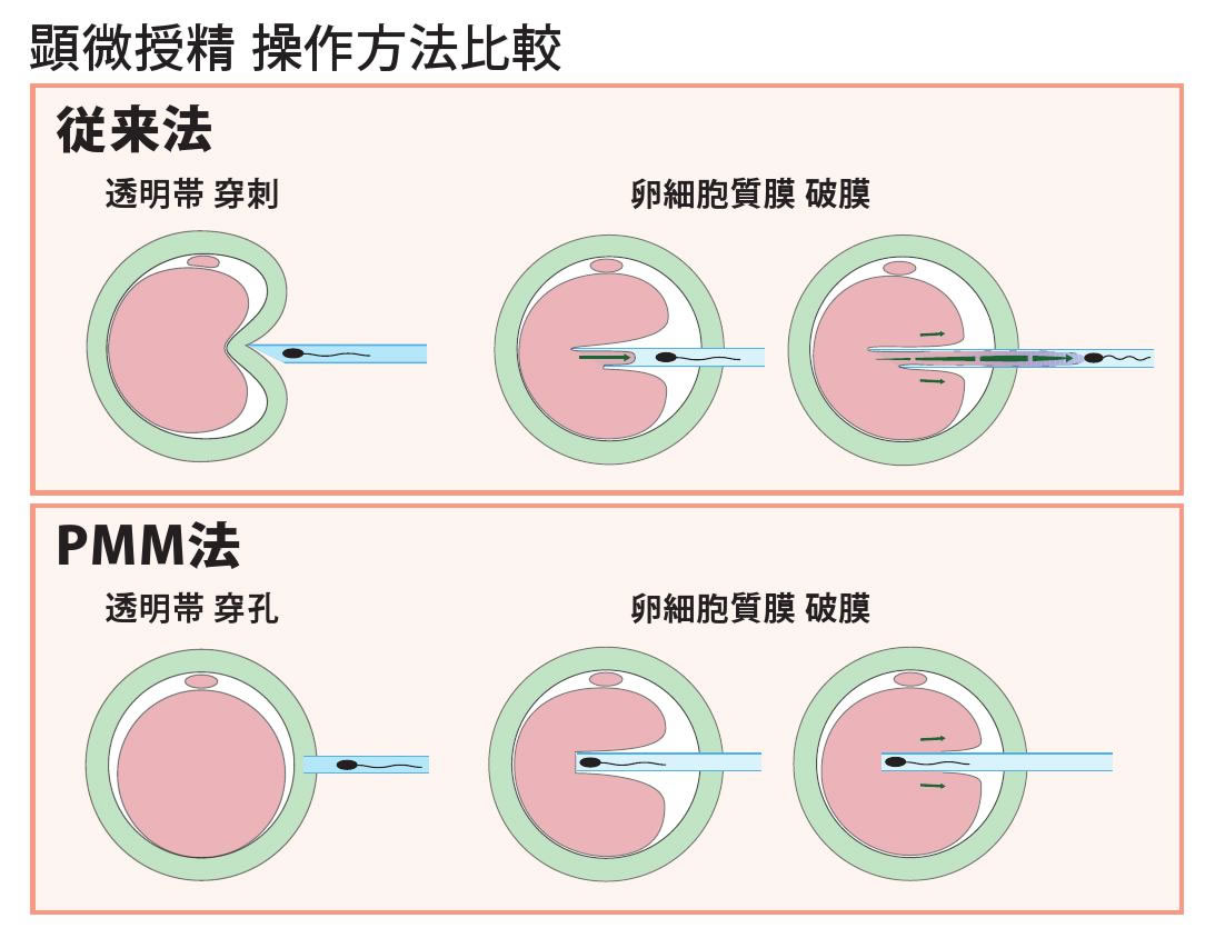 顕微授精 操作方法比較